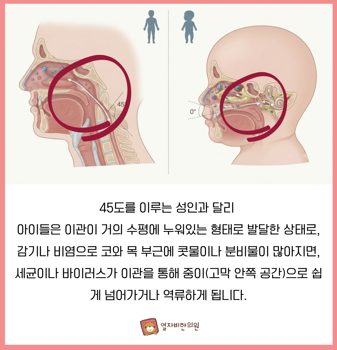 어린이 중이염